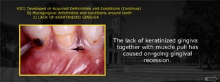 VIII) Developed or Acquired Deformities and Conditions (Continue)        B) Mucogingival deformities and conditions around teeth	    2) LACK OF KERATINIZED GINGIVAThe lack of keratinized gingiva together with muscle pull has caused on-going gingival recession.