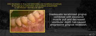 VIII) Developed or Acquired Deformities and Conditions (Continue)        B) Mucogingival deformities and conditions around teeth	    3) DECREASED VESTIBULAR DEPTHInadequate keratinized gingiva combined with excessive muscle pull and decreased vestibular depth has caused progressive gingival recession.