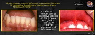 VIII) Developed or Acquired Deformities and Conditions (Continue)        B) Mucogingival deformities and conditions around teeth	    4) ABERRANT FRENUMFor details click on the booksAn aberrant frenum caused excessive tension on the gingival margin and resulted in gingival recession and inflammation.