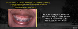 VIII) Developed or Acquired Deformities and Conditions (Continue)        B) Mucogingival deformities and conditions around teeth	    5) Gingival excess		c) EXCESSIVE GINGIVAL DYSPLAY This is an example of excessive gingival display in upper anterior teeth which results in an unesthetic gummy smile.