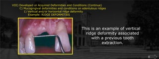 VIII) Developed or Acquired Deformities and Conditions (Continue)        C) Mucogingival deformities and conditions on edentulous ridges	    1) Vertical and/or horizontal ridge deformity		Example: RIDGE DEFORMITIESThis is an example of vertical ridge deformity associated with a previous tooth extraction.