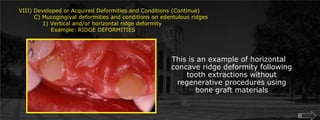 VIII) Developed or Acquired Deformities and Conditions (Continue)        C) Mucogingival deformities and conditions on edentulous ridges	    1) Vertical and/or horizontal ridge deformity		Example: RIDGE DEFORMITIESThis is an example of horizontal concave ridge deformity following tooth extractions without regenerative procedures using bone graft materials