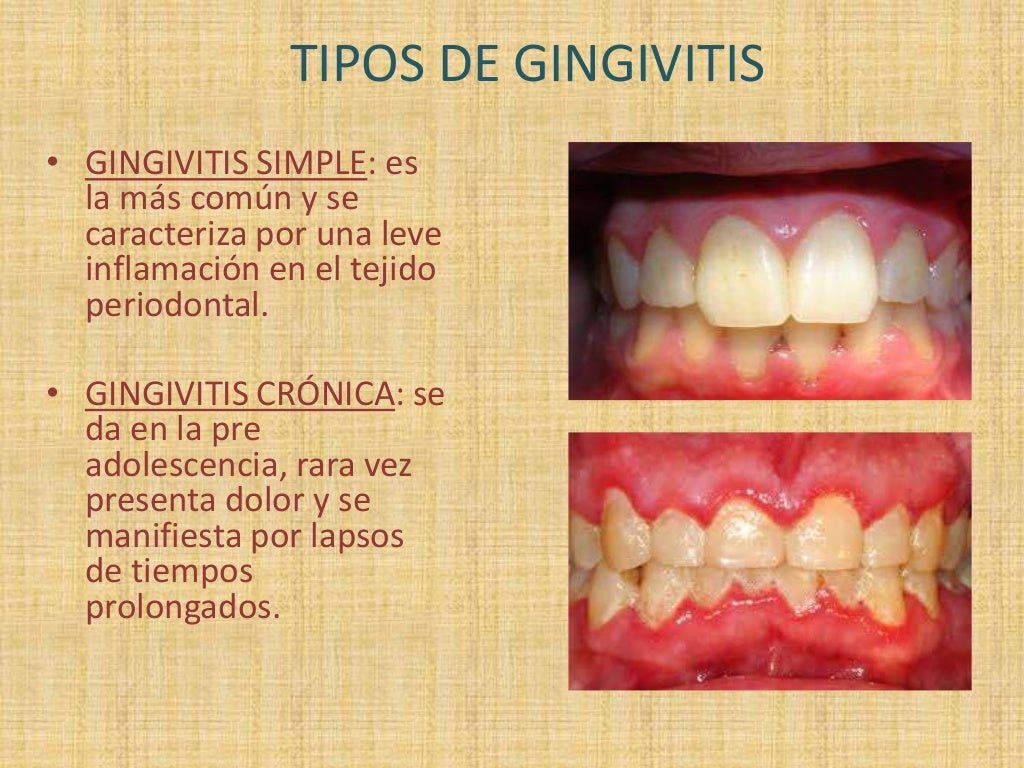 Gingivitis