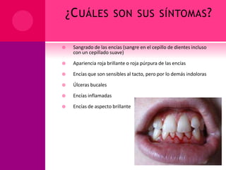¿C UÁLES SON SUS SÍNTOMAS ?


Sangrado de las encías (sangre en el cepillo de dientes incluso
con un cepillado suave)



Apariencia roja brillante o roja púrpura de las encías



Encías que son sensibles al tacto, pero por lo demás indoloras



Úlceras bucales



Encías inflamadas



Encías de aspecto brillante

 