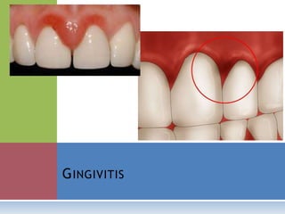 GINGIVITIS
 