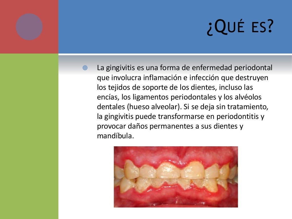 Gingivitis