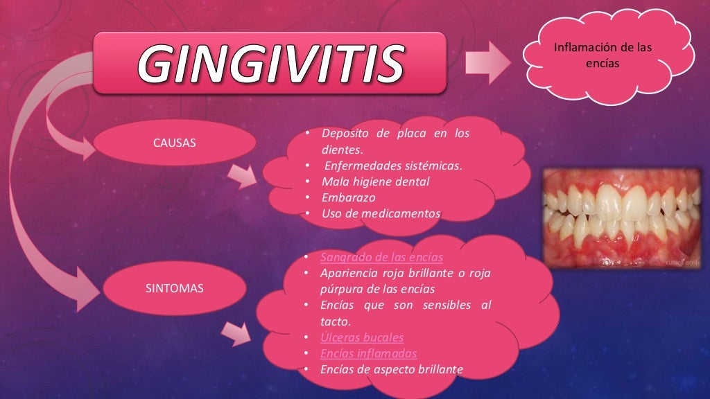 Gingivitis