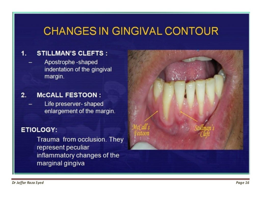 Gingivitis