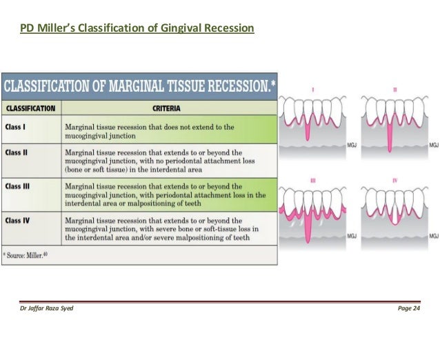 gingivitis miller classification
