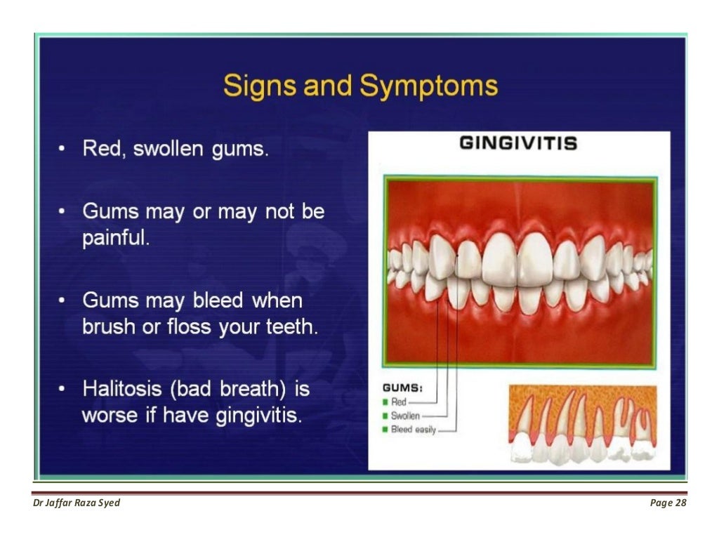 Gingivitis