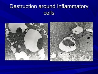 Destruction around InflammatoryDestruction around Inflammatory
cellscells
 