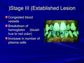 Stage III (Established LesionStage III (Established Lesion((
Congested bloodCongested blood
vesselsvessels
Breakdown ofBreakdown of
hemoglobinhemoglobin (bluish(bluish
hue to red color(hue to red color(
Increase in number ofIncrease in number of
plasma cellsplasma cells
 