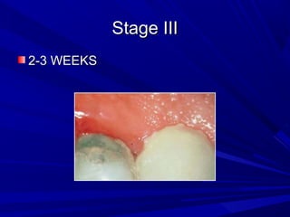Stage IIIStage III
2-3 WEEKS2-3 WEEKS
 