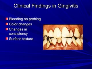Clinical Findings in GingivitisClinical Findings in Gingivitis
Bleeding on probingBleeding on probing
Color changesColor changes
Changes inChanges in
consistencyconsistency
Surface textureSurface texture
 