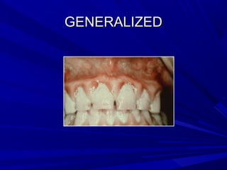 GENERALIZEDGENERALIZED
 