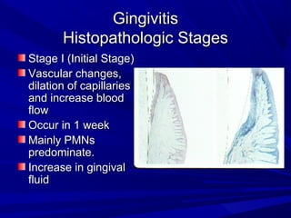 GingivitisGingivitis
Histopathologic StagesHistopathologic Stages
Stage I (Initial Stage)Stage I (Initial Stage)
Vascular changes,Vascular changes,
dilation of capillariesdilation of capillaries
and increase bloodand increase blood
flowflow
Occur in 1 weekOccur in 1 week
Mainly PMNsMainly PMNs
predominate.predominate.
Increase in gingivalIncrease in gingival
fluidfluid
 