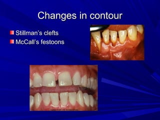 Changes in contourChanges in contour
Stillman’s cleftsStillman’s clefts
McCall’s festoonsMcCall’s festoons
 