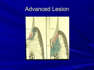 Advanced LesionAdvanced Lesion
 
