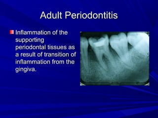 Adult PeriodontitisAdult Periodontitis
Inflammation of theInflammation of the
supportingsupporting
periodontal tissues asperiodontal tissues as
a result of transition ofa result of transition of
inflammation from theinflammation from the
gingiva.gingiva.
 