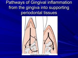 Pathways of Gingival inflammationPathways of Gingival inflammation
from the gingiva into supportingfrom the gingiva into supporting
periodontal tissuesperiodontal tissues
 