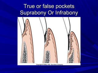 True or false pocketsTrue or false pockets
Suprabony Or InfrabonySuprabony Or Infrabony
 