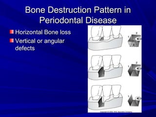 Bone Destruction Pattern inBone Destruction Pattern in
Periodontal DiseasePeriodontal Disease
Horizontal Bone lossHorizontal Bone loss
Vertical or angularVertical or angular
defectsdefects
 