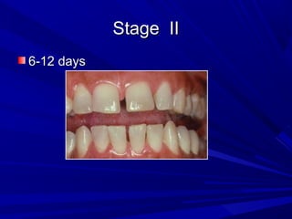 Stage IIStage II
6-12 days6-12 days
 