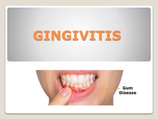 GINGIVITIS
Gum
Disease
 
