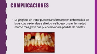 COMPLICACIONES
• La gingivitis sin tratar puede transformarse en enfermedad de
las encías y extenderse al tejido y el hueso una enfermedad
mucho más grave que puede llevar a la pérdida de dientes
 