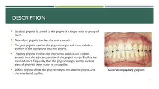 Gingivitis | PPTX