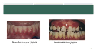 Gingivitis | PPTX