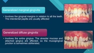 Gingivitis.pptx