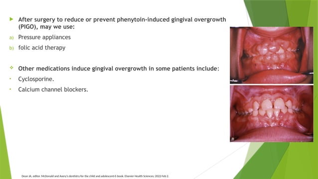 Gingivitis and Periodontal Disease last adjusments.pptx