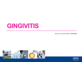 GINGIVITIS
MEDICAL DEPARTMENT DENTAID
 