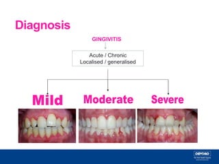 Gingivitis | PPT