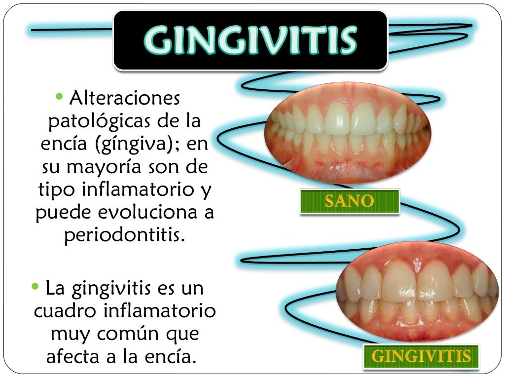 Gingivitis