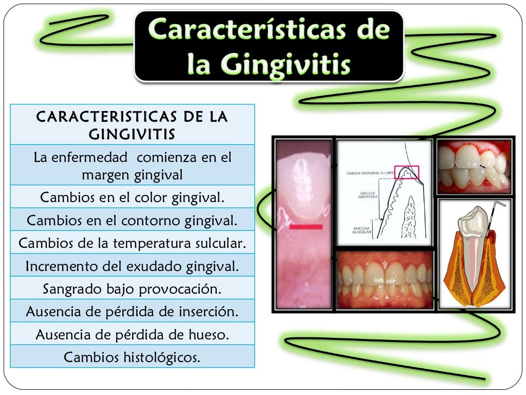 Gingivitis