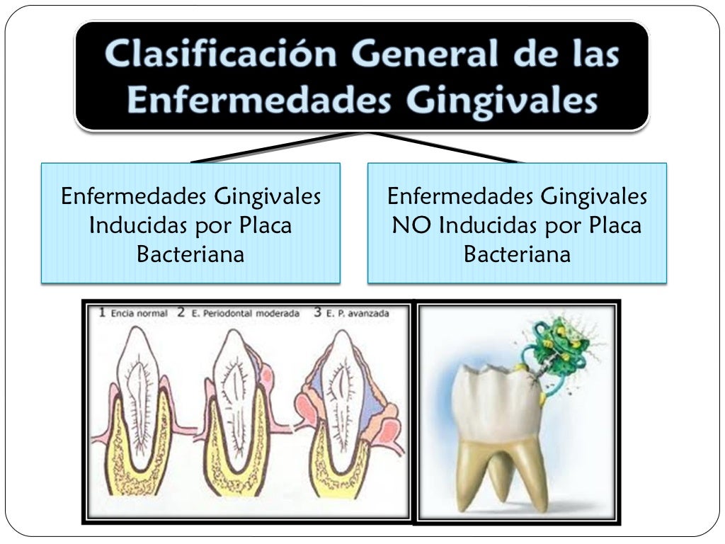 Gingivitis
