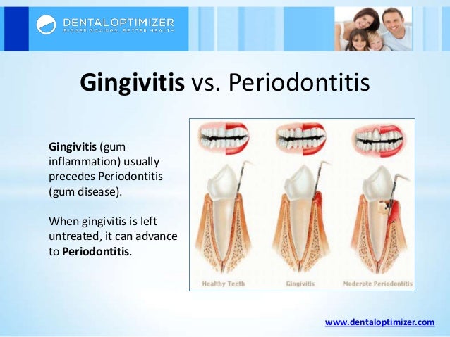 the how to stop gingivitis periodontitis vs gingivitis