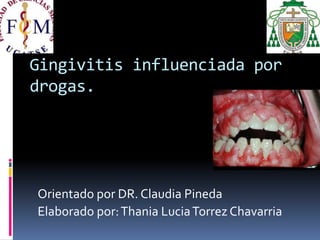 Gingivitis influenciada por
drogas.
Orientado por DR. Claudia Pineda
Elaborado por:Thania LuciaTorrez Chavarria
 