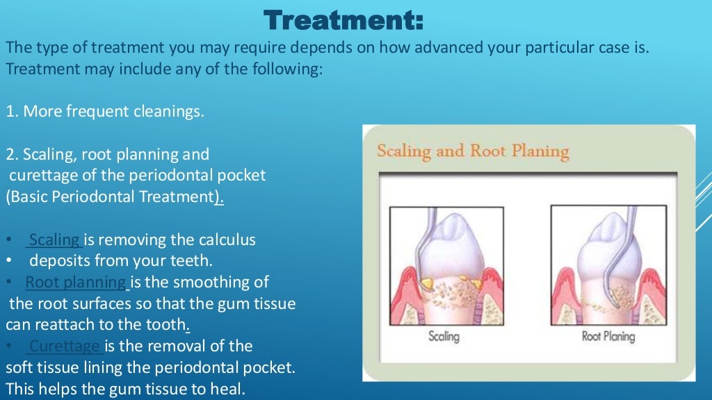 Gingivitis presentation