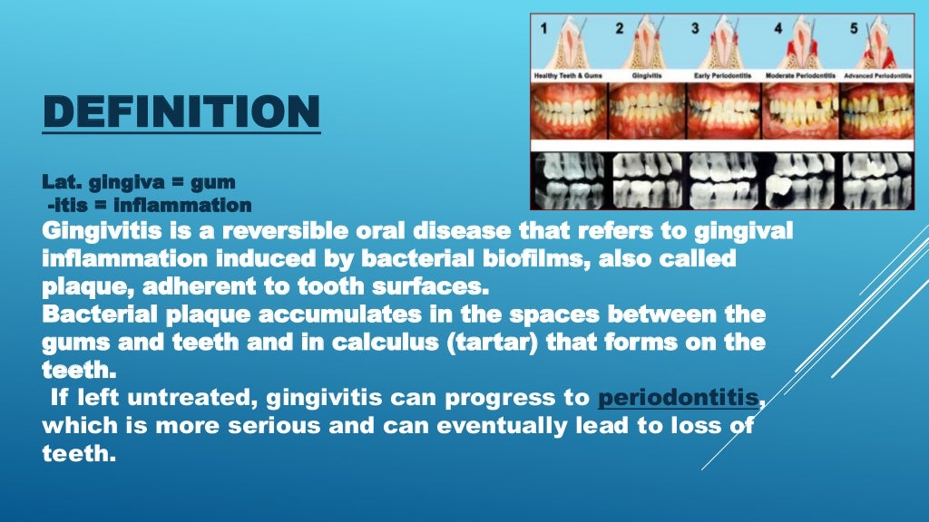Gingivitis presentation