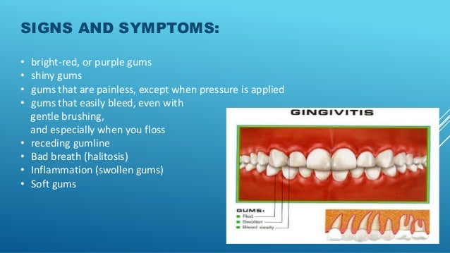 gingivitis symptoms