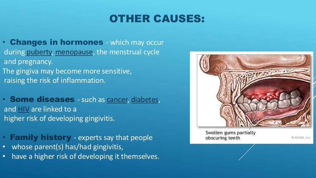 Gingivitis presentation