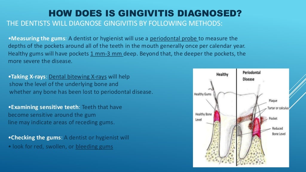 Gingivitis presentation