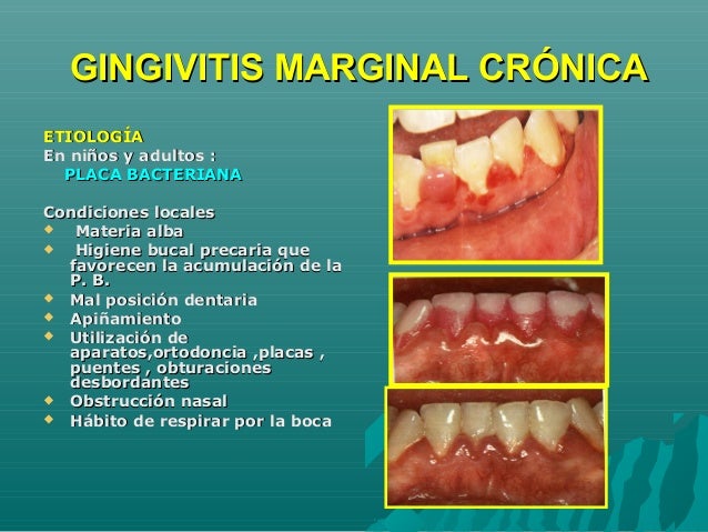 Gingivitis
