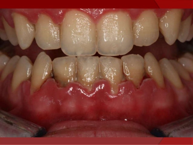 gingivitis-ulcerosa-pdf-how-oral-specialists-can-help-diagnose-and