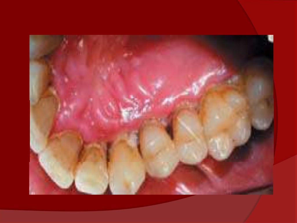 Gingivitis ulcero necrotizante (gun)