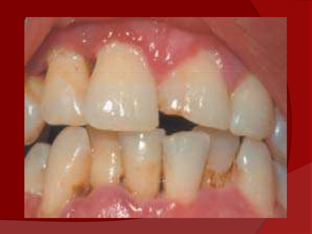 Gingivitis ulcero necrotizante (gun)