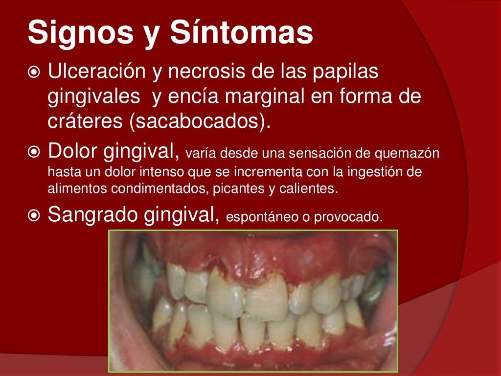 Gingivitis ulcero necrotizante (gun)